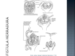 Zinner, Ashley, Maingot’s Abdominal Operations, 11ª Ed
 