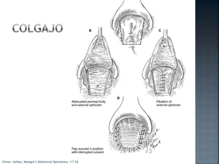 Zinner, Ashley, Maingot’s Abdominal Operations, 11ª Ed
 