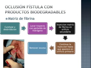  Matriz de fibrina
Curetaje y
desbridacion
Lavar trayecto
con peróxido de
hidrógeno
Inyeccion matriz
de fibrina en
orificio
secundario
Continua la
inyeccion hasta
que aparece en
orificio primario
Remover exceso
 