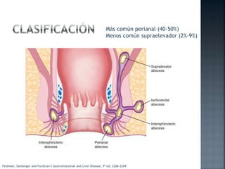 Más común perianal (40-50%)
Menos común supraelevador (2%-9%)
Feldman, Sleisenger and Fordtran’s Gastrointestinal and Liver Disease, 9ª ed, 2266-2269
 