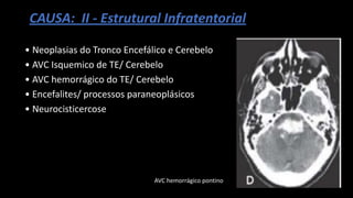 CAUSA: II - Estrutural Infratentorial
• Neoplasias do Tronco Encefálico e Cerebelo
• AVC Isquemico de TE/ Cerebelo
• AVC hemorrágico do TE/ Cerebelo
• Encefalites/ processos paraneoplásicos
• Neurocisticercose
AVC hemorrágico pontino
 