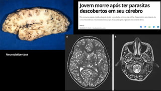 Neurocisticercose
 