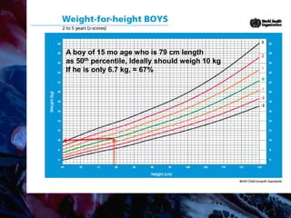 A boy of 15 mo age who is 79 cm length
as 50th percentile, Ideally should weigh 10 kg
If he is only 6.7 kg, = 67%
 