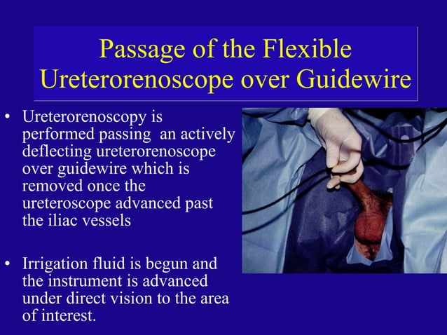 Retrograde Intrarenal Ureteroscopic Surgery (RIRS) | PPT