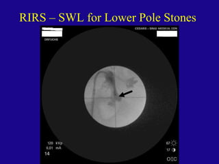 Retrograde Intrarenal Ureteroscopic Surgery (RIRS) | PPT