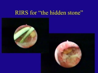 Retrograde Intrarenal Ureteroscopic Surgery (RIRS) | PPT