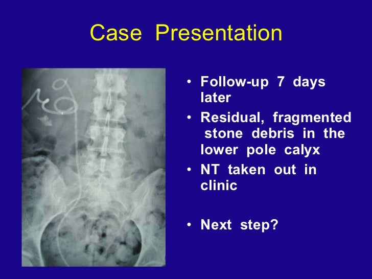Retrograde Intrarenal Ureteroscopic Surgery (RIRS)