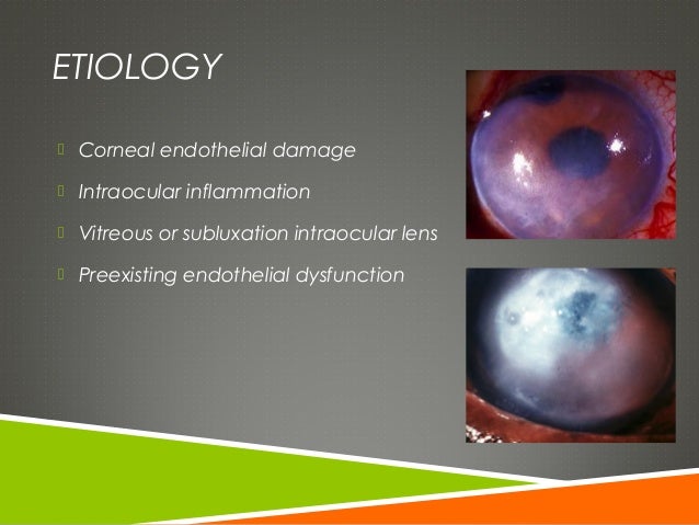 Fuchs dystrophy and pseudophakic bullous keratopathy