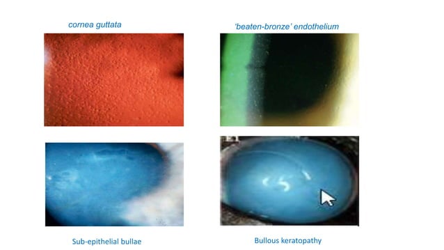 Ebmd Vs Rce Fuchs endothelial dystrophy mahfuz.pptx | Eye and Vision Conditions ...