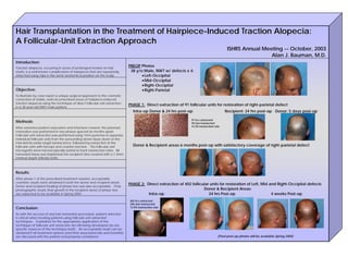 Hair Transplantation in the Treatment of Hairpiece-Induced Traction Alopecia:
A Follicular-Unit Extraction Approach
                                                                                                                                           ISHRS Annual Meeting -- October, 2003
                                                                                                                                                           Alan J. Bauman, M.D.
Introduction:
Traction alopecia, occurring in areas of prolonged tension on hair
                                                                              PREOP Photos
shafts, is a well-known complication of hairpieces that are repeatedly         38 y/o Male, NW7 w/ defects x 4:
attached using clips in the same anatomical position on the scalp.                    Left-Occipital
                                                                                      Mid-Occipital
                                                                                      Right-Occipital
Objective:                                                                            Right-Parietal
To illustrate by case report a unique surgical approach to the cosmetic
correction of stable, well-circumscribed areas of hairpiece-induced
traction alopecia using the technique of direct follicular unit extraction
                                                                              PHASE 1: Direct extraction of 91 follicular units for restoration of right-parietal defect
in a 38 year-old NW7 male patient.
                                                                                Intra-op Donor & 24 hrs post-op                           Recipient: 24 hrs post-op Donor: 5 days post-op

                                                                                                                 91 fu’s extracted
Methods:                                                                                                         78 non-transected
                                                                                                                 14.3% transection rate
After extensive patient education and informed consent, the planned
restoration was performed in two phases spaced six months apart.
Follicular unit extraction was performed using 1mm punches to separate
individual follicular units from the surrounding donor tissue down to the
mid-dermis under turgid tumescence, followed by extraction of the
follicular units with forceps and counter-traction. The follicular unit         Donor & Recipient areas 6 months post-op with satisfactory coverage of right-parietal defect
micrografts were microscopically sorted to track transection rates. All
harvested tissue was implanted into recipient sites created with a 1.3mm
minimal depth (Minde) knife.



Results:
After phase 1 of the prescribed treatment sessions, acceptable
cosmetic results were obtained in both the donor and recipient areas.
                                                                              PHASE 2: Direct extraction of 402 follicular units for restoration of Left, Mid and Right-Occipital defects
Donor and recipient healing of phase two was also acceptable. Final
photographic results (hair growth in the recipient area) of phase two                                                  Donor & Recipient Areas:
are expected to be available in Spring 2004.                                            Intra-op                          24 hrs Post-op                       4 weeks Post-op
                                                                              402 fu’s extracted
                                                                              346 non-transected
Conclusion:                                                                   13.9% transection rate

As with the success of any hair restoration procedure, patient selection
is critical when treating patients using follicular unit extraction
techniques. Guidelines for the appropriate application of the
technique of follicular unit extraction are still being developed (as are
specific nuances of the technique itself). An acceptable result can be
obtained if all treatment options (and their associated risks and benefits)
are discussed with the patient and properly considered.                                                                              (Final post-op photos will be available Spring 2004)
 