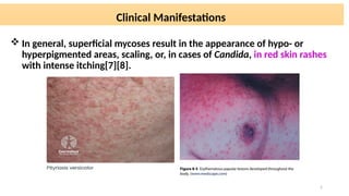 Comprehensive Overview of Fungal Skin Infections: Epidemiology ...