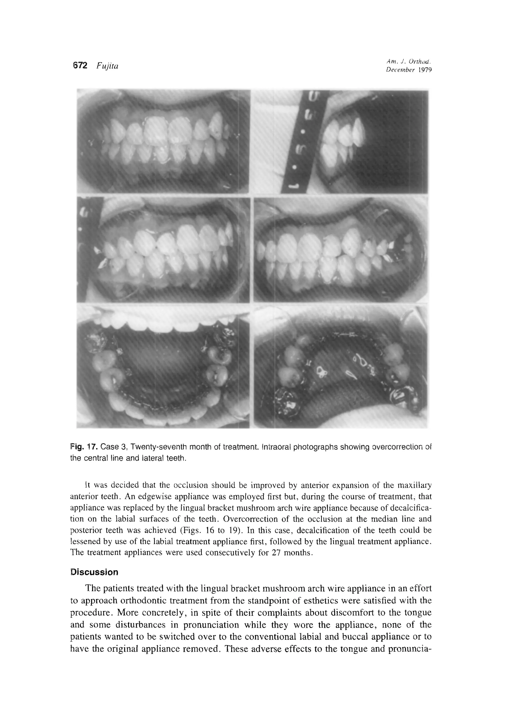 Fujita lingual orthodontics ajo article | PDF