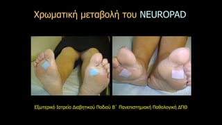 Χρωματική μεταβολή του NEUROPAD 
Εξωτερικό Ιατρείο Διαβητικού Ποδιού Β΄ Πανεπιστημιακή Παθολογική ΔΠΘ 
 