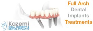 Full Arch
Dental
Implants
Treatments
 