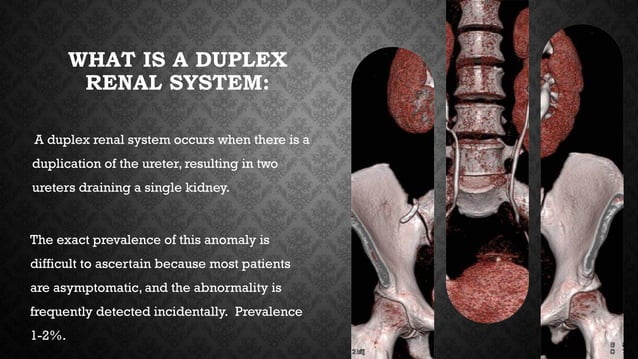 Duplex renal systemComplete/Partial Duplex Renal System, .pptx