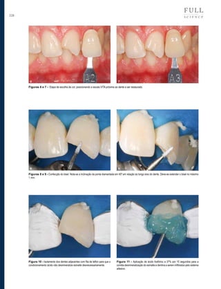 228

6

7

Figuras 6 e 7 - Etapa de escolha de cor, posicionando a escala VITA próxima ao dente a ser restaurado.

8

9

Figuras 8 e 9 - Confecção do bisel. Nota-se a inclinação da ponta diamantada em 45º em relação ao longo eixo do dente. Deve-se extender o bisel no máximo
1 mm.

Figura 10 - Isolamento dos dentes adjacentes com fita de teflon para que o
condicionamento ácido não desmineralize esmalte desnecessariamente.

Figura 11 - Aplicação de ácido fosfórico a 37% por 15 segundos para a
correta desmineralização do esmalte e dentina a serem infiltrados pelo sistema
adesivo.

 