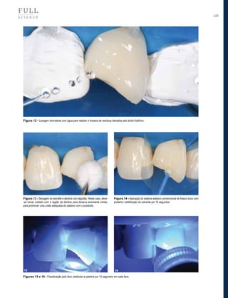 229

Figura 12 - Lavagem abundante com água para realizar a limpeza de resíduos deixados pelo ácido fosfórico.

Figura 13 - Secagem do esmalte e dentina com algodão. Neste caso, deve-se tomar cuidado com a região de dentina para deixá-la levemente úmida,
para promover uma união adequada do adesivo com o substrato.

Figura 14 - Aplicação do sistema adesivo convencional de frasco único com
posterior volatilização do solvente por 10 segundos.

15

16

Figuras 15 e 16 - Fotoativação pela face vestibular e palatina por 10 segundos em cada face.

 
