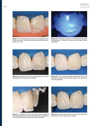 230

Figura 17 - Posicionamento da guia de silicone na face palatina do incisivo
fraturado. Nota-se que a resina deve ser posicionada sem ser fotoativada juntamente com a matriz.

Figura 18 - Fotoativação da camada de resina translúcida correspondente
ao esmalte palatino – Esmalte A1 (Four Seasons, Ivoclar Vivadent, Schaan,
Lietchtenstein).

Figura 19 - Aplicação de uma resina opaca correspondente ao halo opaco
incisal (Bleach XX, Four Seasons, Ivoclar Vivadent).

Figura 20 - Início da inserção da camada correspondente à dentina com
resina A2D (Four Seasons, Ivoclar Vivadent). Nota-se o início da construção
dos mamelos dentinários.

Figura 21 - Vista lateral do incisivo a ser restaurado. Nota-se a projeção da
resina opaca correspondente à dentina, dando formato aos mamelos dentinários, porém deixando espaço para as resinas de efeito e translúcidas.

Figura 22 - Inserção da resina de efeito translúcida sobre os mamelos dentinários (Clear Trans, Four Seasons, Ivoclar Vivadent).

 
