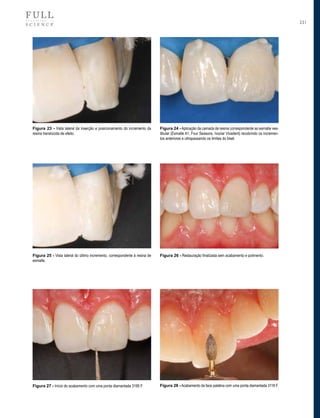 231

Figura 23 - Vista lateral da inserção e posicionamento do incremento da
resina translúcida de efeito.

Figura 24 - Aplicação da camada de resina correspondente ao esmalte vestibular (Esmalte A1, Four Seasons, Ivoclar Vivadent) recobrindo os incrementos anteriores e ultrapassando os limites do bisel.

Figura 25 - Vista lateral do último incremento, correspondente à resina de
esmalte.

Figura 26 - Restauração finalizada sem acabamento e polimento.

Figura 27 - Início do acabamento com uma ponta diamantada 3195 F.

Figura 28 - Acabamento da face palatina com uma ponta diamantada 3118 F.

 