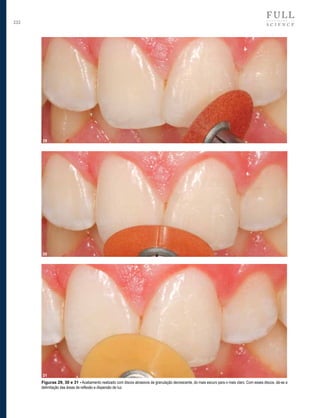 232

29

30

31
Figuras 29, 30 e 31 - Acabamento realizado com discos abrasivos de granulação decrescente, do mais escuro para o mais claro. Com esses discos, dá-se a
delimitação das áreas de reflexão e dispersão de luz.

 