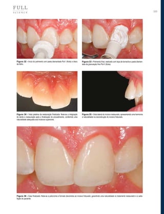 233

Figura 32 - Início do polimento com pasta diamantada Poli I (Kota) e disco
de feltro.

Figura 33 - Polimento final, realizado com taça de borracha e pasta diamantada de granulação fina Poli II (Kota).

Figura 34 - Vista palatina da restauração finalizada. Nota-se a integração
do dente e restauração após a finalização do procedimento, conferindo uma
naturalidade adequada aos incisivos superiores.

Figura 35 - Vista lateral do incisivo restaurado, apresentando uma harmonia
e naturalidade na reconstrução do incisivo fraturado.

Figura 36 - Caso finalizado. Nota-se a policromia e formato devolvidos ao incisivo fraturado, garantindo uma naturalidade no tratamento restaurador e a satisfação do paciente.

 