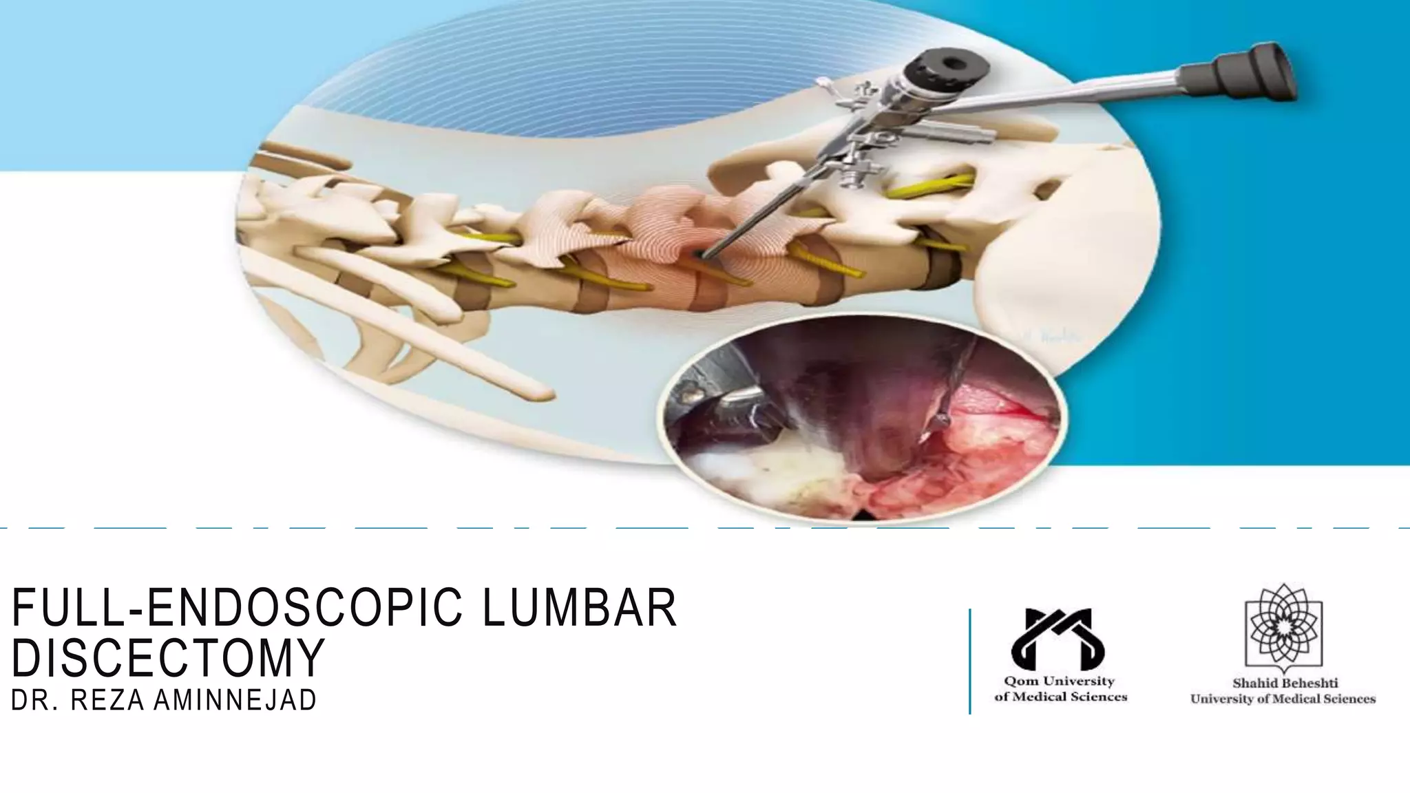 Full Endoscopic Lumbar Discectomy PPT