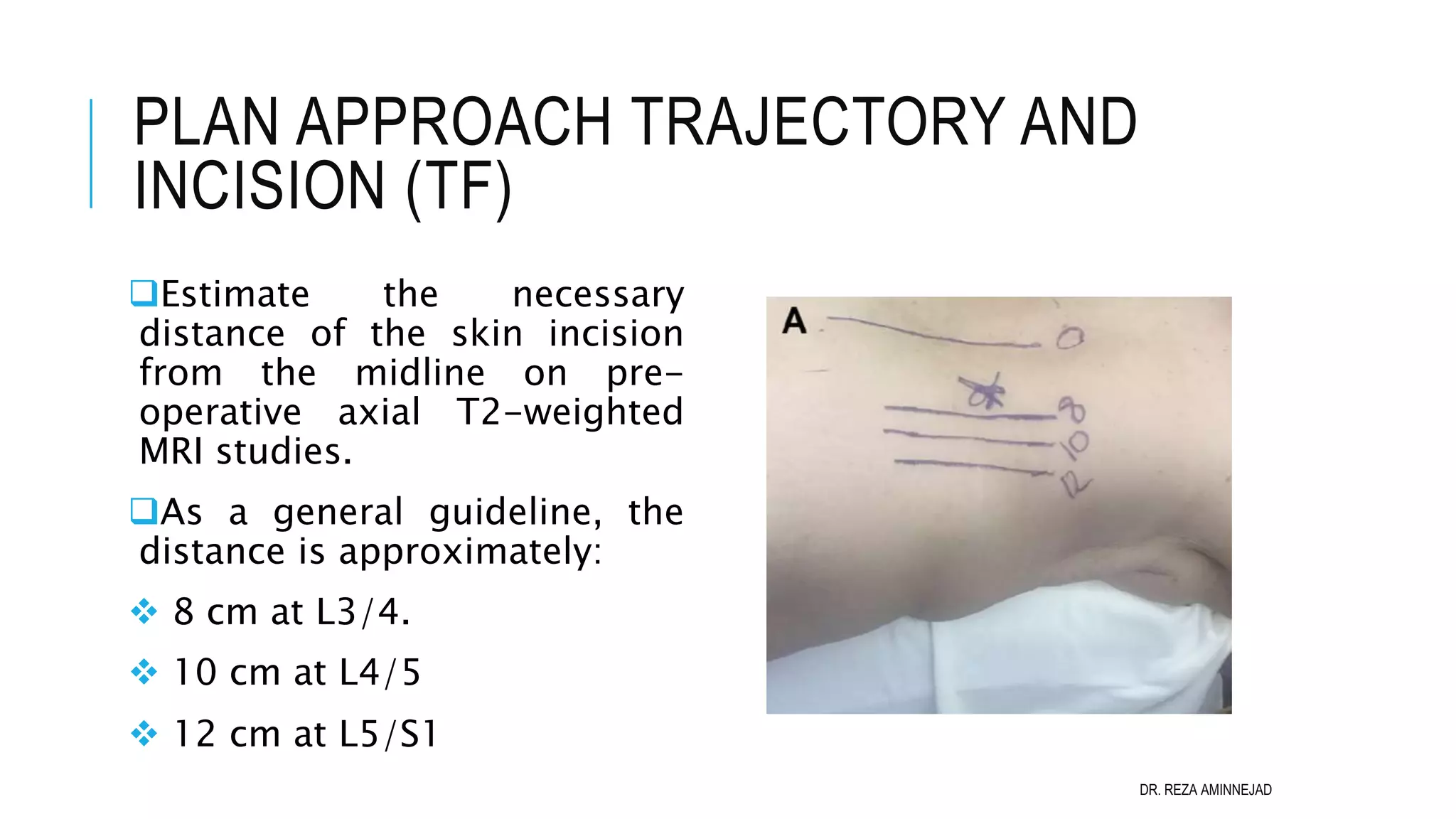 Full Endoscopic Lumbar Discectomy PPT