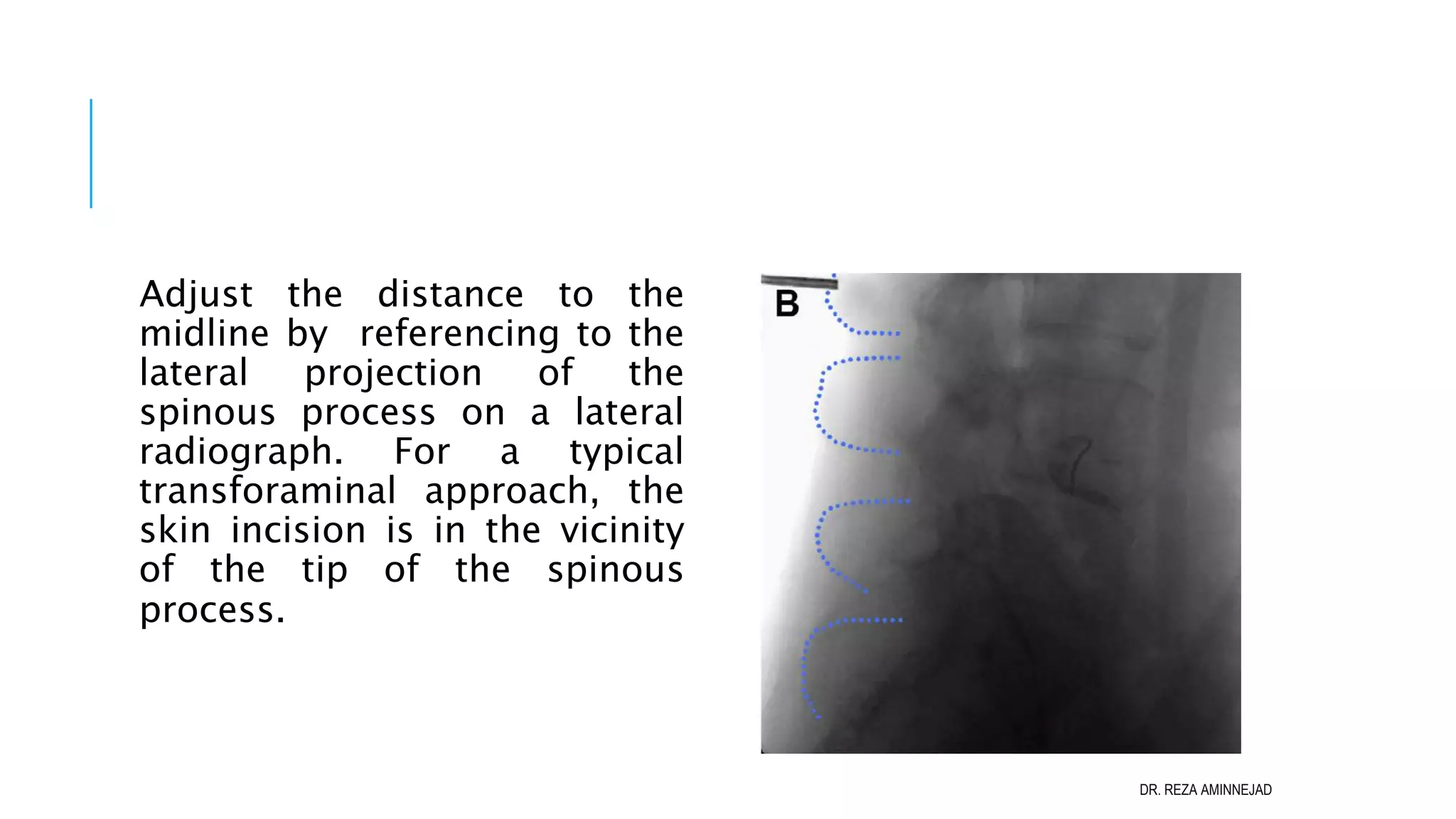 Full Endoscopic Lumbar Discectomy PPT