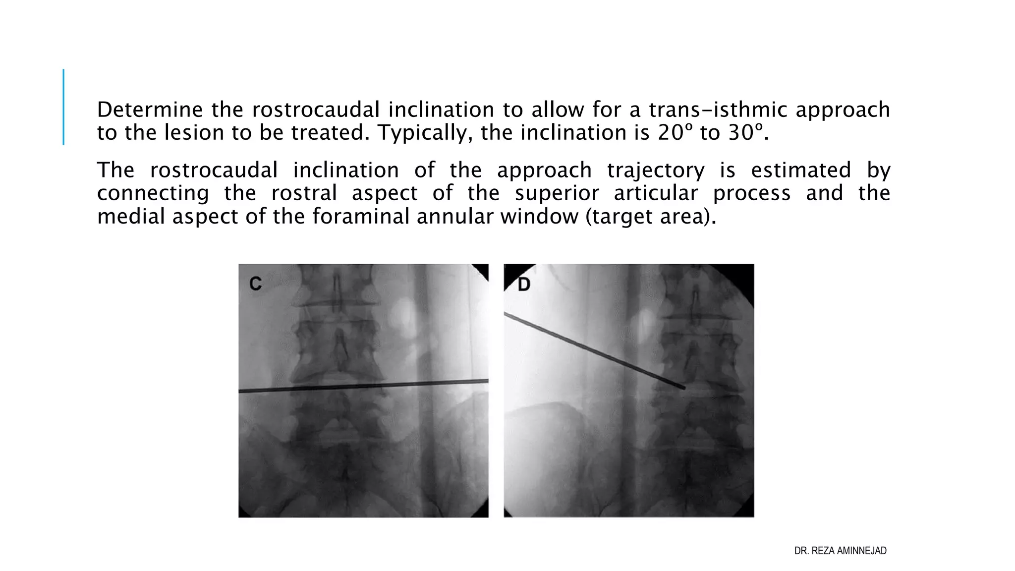 Full Endoscopic Lumbar Discectomy PPT