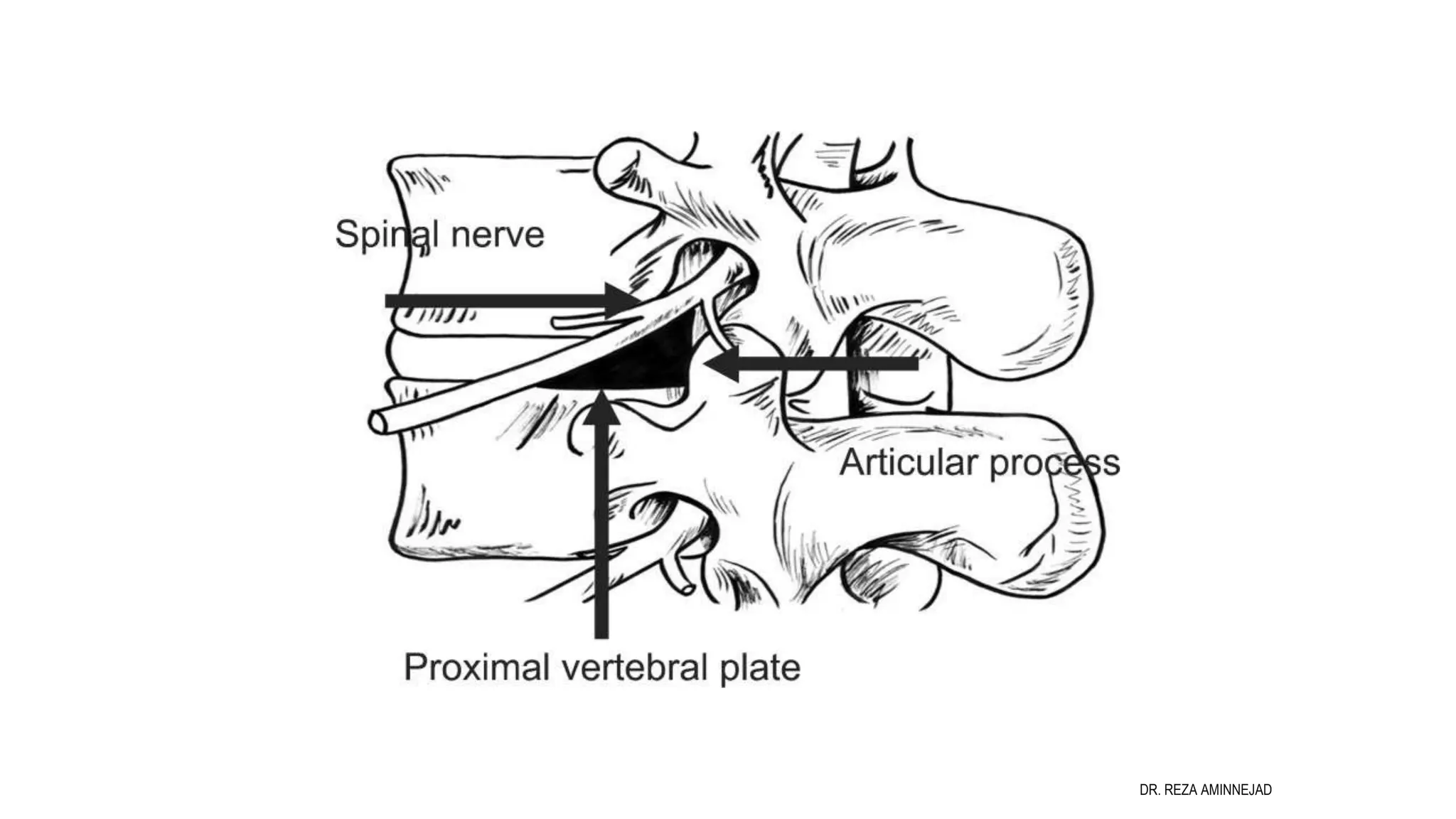 Full Endoscopic Lumbar Discectomy PPT