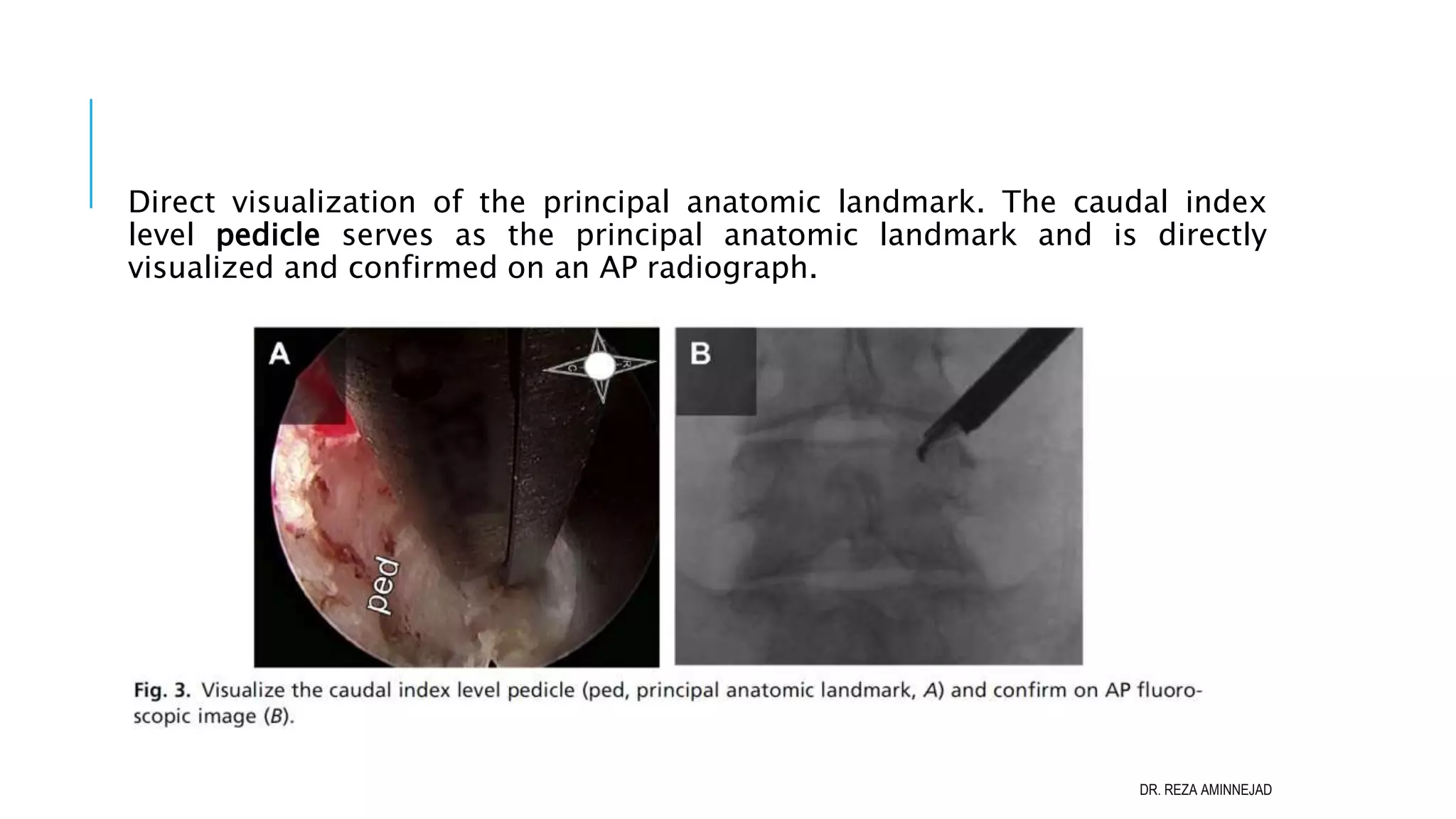 Full Endoscopic Lumbar Discectomy PPT