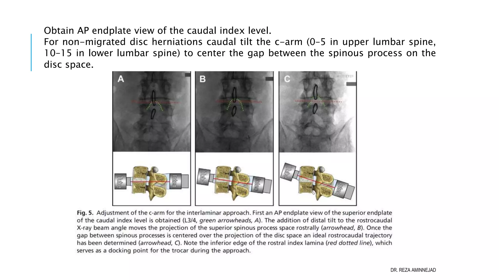 Full Endoscopic Lumbar Discectomy PPT