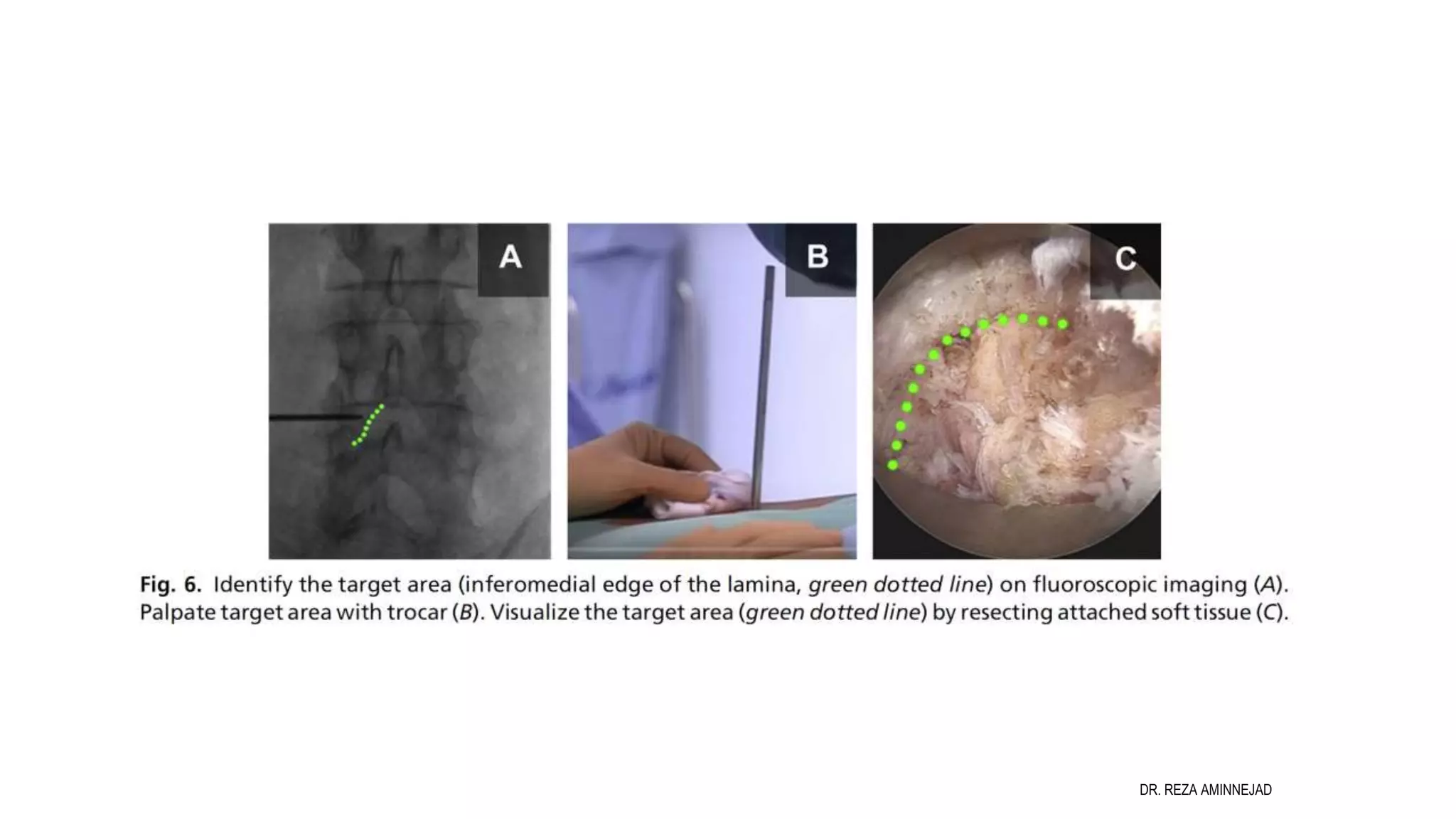 Full Endoscopic Lumbar Discectomy PPT