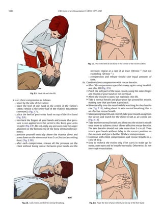 1280                                                       R.W. Koster et al. / Resuscitation 81 (2010) 1277–1292




                                                                                               Fig. 2.7. Place the heel of one hand in the centre of the victim’s chest.



                                                                                                 sternum; repeat at a rate of at least 100 min−1 (but not
                                                                                                 exceeding 120 min−1 );
                                                                                               ◦ compression and release should take equal amounts of
                                                                                                 time.
                                                                                         6a. Combine chest compression with rescue breaths.
                                                                                             • After 30 compressions open the airway again using head tilt
                                                                                               and chin lift (Fig. 2.5).
                                                                                             • Pinch the soft part of the nose closed, using the index ﬁnger
                      Fig. 2.5. Head tilt and chin lift.                                       and thumb of your hand on the forehead.
                                                                                             • Allow the mouth to open, but maintain chin lift.
   • start chest compression as follows:                                                     • Take a normal breath and place your lips around his mouth,
     ◦ kneel by the side of the victim;                                                        making sure that you have a good seal.
     ◦ place the heel of one hand in the centre of the victim’s                              • Blow steadily into the mouth while watching for the chest to
       chest; (which is the lower half of the victim’s breastbone                              rise (Fig. 2.11), taking about 1 s as in normal breathing; this is
       (sternum)) (Fig. 2.7);                                                                  an effective rescue breath.
     ◦ place the heel of your other hand on top of the ﬁrst hand                             • Maintaining head tilt and chin lift, take your mouth away from
       (Fig. 2.8);                                                                             the victim and watch for the chest to fall as air comes out
     ◦ interlock the ﬁngers of your hands and ensure that pres-                                (Fig. 2.12).
       sure is not applied over the victim’s ribs. Keep your arms                            • Take another normal breath and blow into the victim’s mouth
       straight (Fig. 2.9). Do not apply any pressure over the upper                           once more to achieve a total of two effective rescue breaths.
       abdomen or the bottom end of the bony sternum (breast-                                  The two breaths should not take more than 5 s in all. Then
       bone);                                                                                  return your hands without delay to the correct position on
     ◦ position yourself vertically above the victim’s chest and                               the sternum and give a further 30 chest compressions.
       press down on the sternum at least 5 cm (but not exceeding                            • Continue with chest compressions and rescue breaths in a
       6 cm) (Fig. 2.10);                                                                      ratio of 30:2.
     ◦ after each compression, release all the pressure on the                               • Stop to recheck the victim only if he starts to wake up: to
       chest without losing contact between your hands and the                                 move, open eyes and to breathe normally. Otherwise, do not
                                                                                               interrupt resuscitation.




            Fig. 2.6. Look, listen and feel for normal breathing.                                Fig. 2.8. Place the heel of your other hand on top of the ﬁrst hand.
 