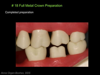 # 18 Full Metal Crown Preparation
Completed preparation
Anna Organ-Boshes, DDS
 