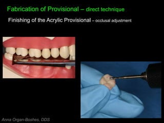 Fabrication of Provisional – direct technique
Finishing of the Acrylic Provisional – occlusal adjustment
Anna Organ-Boshes, DDS
 