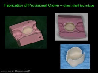 Fabrication of Provisional Crown – direct shell technique
Anna Organ-Boshes, DDS
 