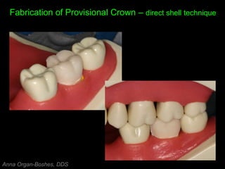Fabrication of Provisional Crown – direct shell technique
Anna Organ-Boshes, DDS
 