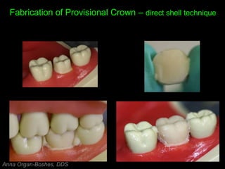 Fabrication of Provisional Crown – direct shell technique
Anna Organ-Boshes, DDS
 