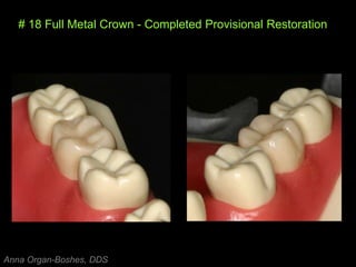 # 18 Full Metal Crown - Completed Provisional Restoration
Anna Organ-Boshes, DDS
 