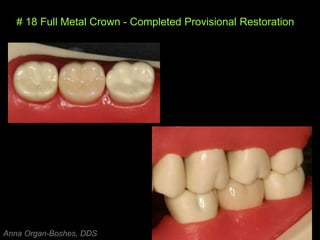# 18 Full Metal Crown - Completed Provisional Restoration
Anna Organ-Boshes, DDS
 