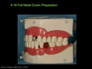 # 18 Full Metal Crown Preparation
Anna Organ-Boshes, DDS
 