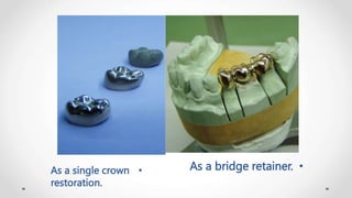 Retainer In Bridge full metal.pptx