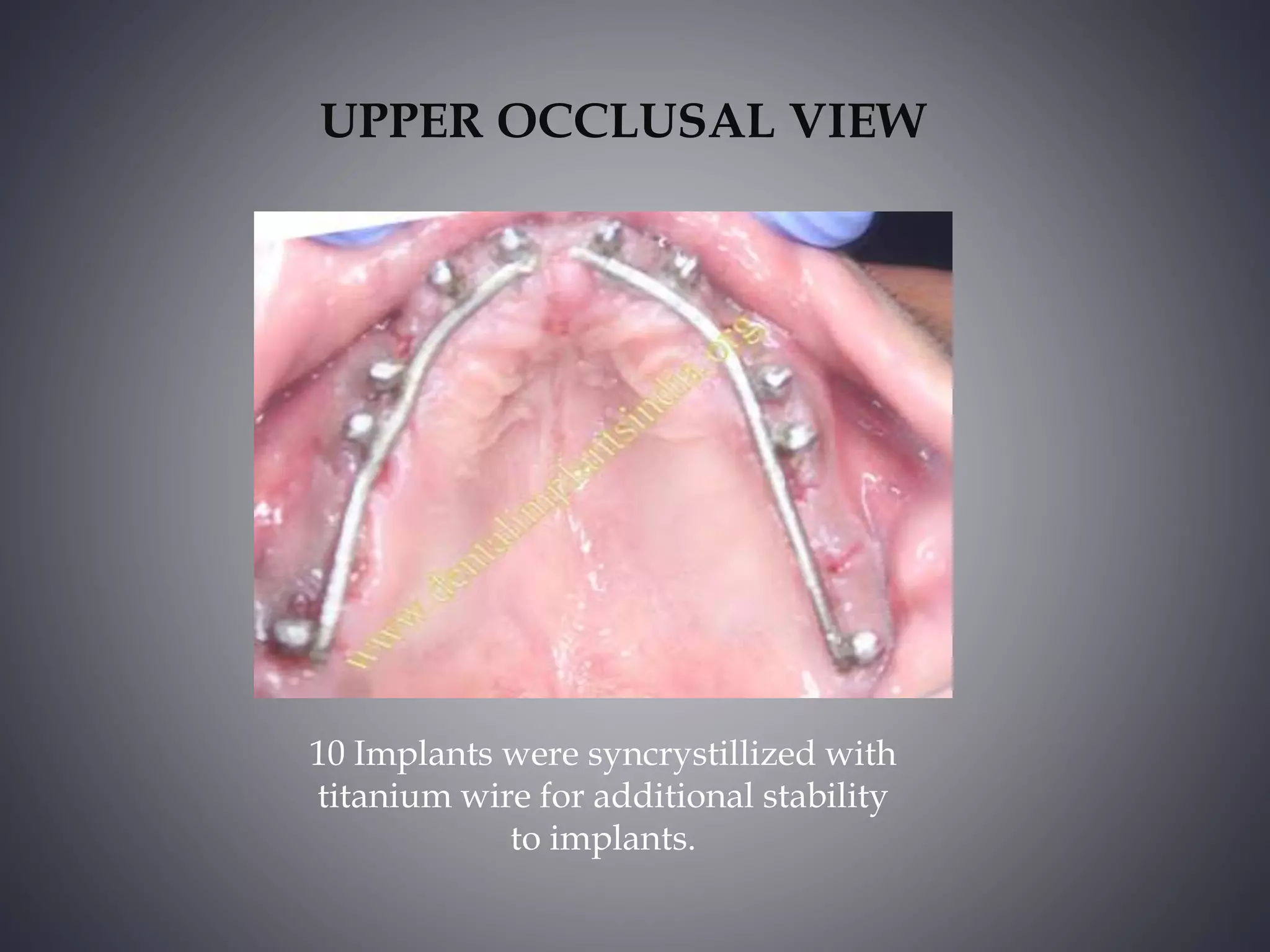full-mouth-rehabilitation-with-dental-implants-a-case-report-in-india