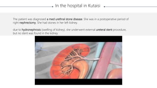 The patient was diagnosed a med urethral stone disease. She was in a postoperative period of
right nephrectomy. She had stones in her left kidney.
due to hydronephrosis (swelling of kidney), she underwent external ureteral stent procedure,
but no stent was found in the kidney.
In the hospital in Kutaisi
 
