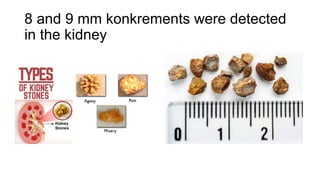 8 and 9 mm konkrements were detected
in the kidney
 
