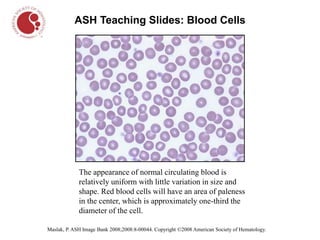 Maslak, P. ASH Image Bank 2008;2008:8-00044. Copyright ©2008 American Society of Hematology.
ASH Teaching Slides: Blood Cells
The appearance of normal circulating blood is
relatively uniform with little variation in size and
shape. Red blood cells will have an area of paleness
in the center, which is approximately one-third the
diameter of the cell.
 