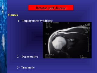 Rotator cuff disease
Causes
         1 – Impingement syndrome




     2 – Degenerative


     3 - Traumatic
 