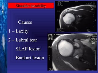 Shoulder instability



     Causes
1 – Laxity
2 – Labral tear
   SLAP lesion
   Bankart lesion
 