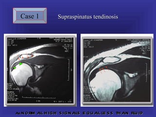 Case 1           Supraspinatus tendinosis




Ab norm   al h igh s ignals e qu al le s s th an flu id
 